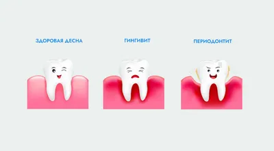 Гранулематозный периодонтит | Симптомы, лечение, профилактика | Клиника  семейной стоматологии Дока-Дент