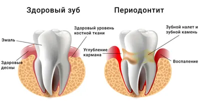 Хронический периодонтит, лечение, цена в Москве