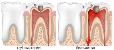 Периодонтит: качественное лечение в Харькове