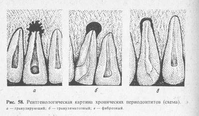 Периодонтит: Лечение периодонтита зуба в Киеве - цена в 32Dent