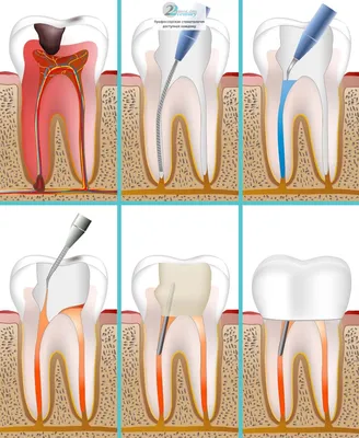 🦷Периодонтит зуба: цена лечения в Москве