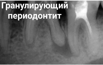 Лечение острого периодонтита зубов в стоматологии - цены в Москве