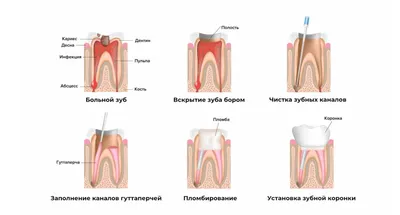 Хронический гранулематозный периодонтит - радикулярная киста(обострение)