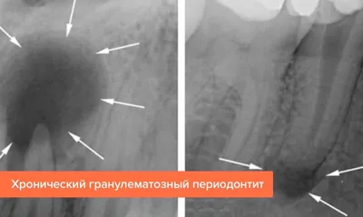 Периодонтит — это воспалительный процесс тканей, которые находятся за  пределами зуба, при котором инфекция проникает из пульповой камеры в  периодонт. | SMAGA dental clinic