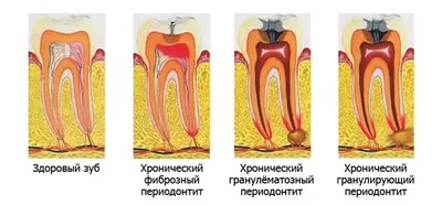 Периодонтит: качественное лечение в Харькове