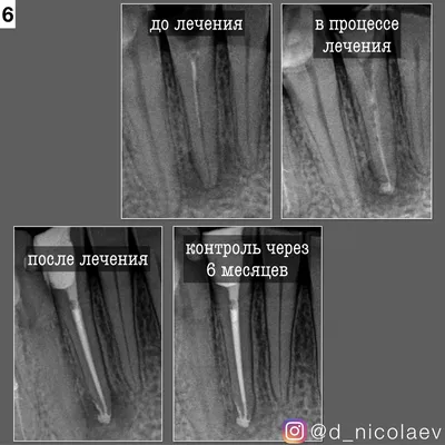 Периодонтит — это воспалительный процесс тканей, которые находятся за  пределами зуба, при котором инфекция проникает из пульповой камеры в  периодонт. | SMAGA dental clinic