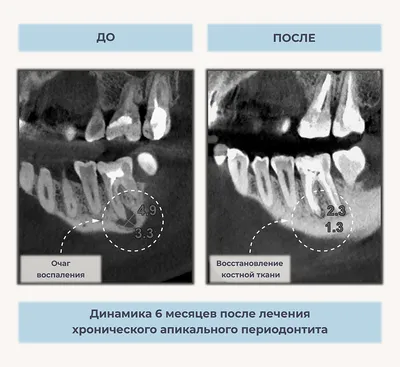 Лечение каналов зуба при периодонтите - Diamond Dent