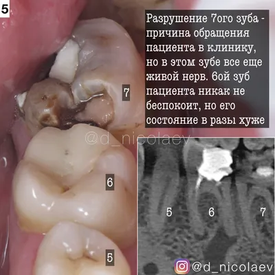 Периодонтит — виды заболевания и способы лечения