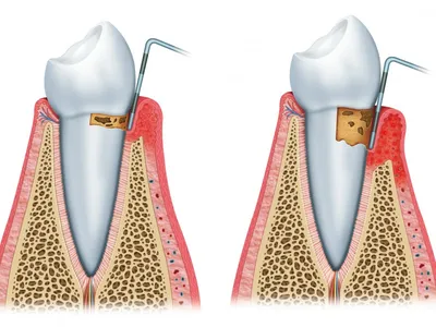 Что такое периодонтит - Доказательная медицина для всех