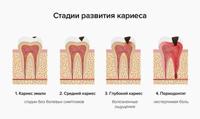 Апикальный периодонтит — Википедия