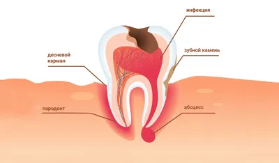 Периодонтит: виды и лечение у взрослых и детей