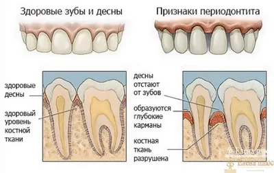 Периодонтит зуба — симптомы, виды, причины возникновения | Как лечить  периодонтит?