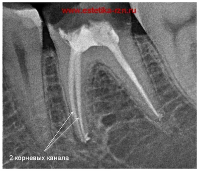Хронический Апикальный Периодонтит-Клиника Диагностика Лечение