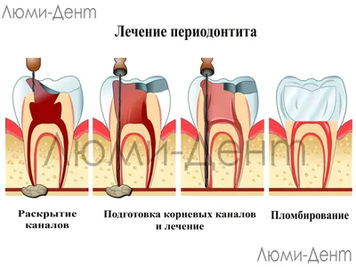 Периодонтит молочного зуба: можно ли вылечить? - Евромед Дентал