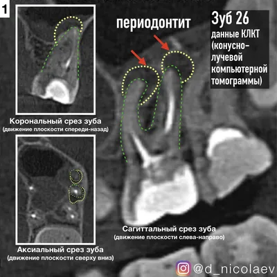 Это касается всех, у кого есть зубы! Периодонтит. Тактика действий в разных  ситуациях. | Блог о стоматологии. Доктор Ижмукóв. | Дзен