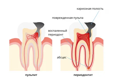 ПЕРИОДОНТИТ – СИМПТОМЫ, ВИДЫ, ЛЕЧЕНИЕ – Ортодонт-гнатолог в спб  (санкт-петербург). Леонтьева Алена Владимировна