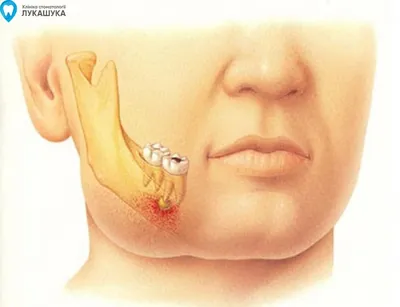 Периостит челюсти – лечение, гнойный, острый, мкб, диагностика
