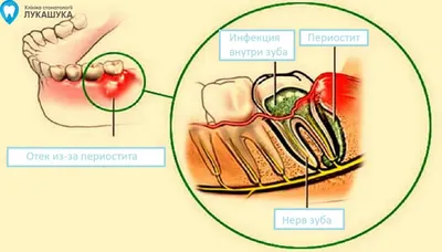 Периостит челюсти и его лечение | Доктор Анна Борисова-Волконская | Дзен