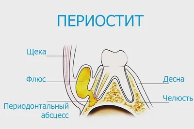 Флюс (периостит челюсти) — что это такое, причины возникновения,  диагностика и методы лечения