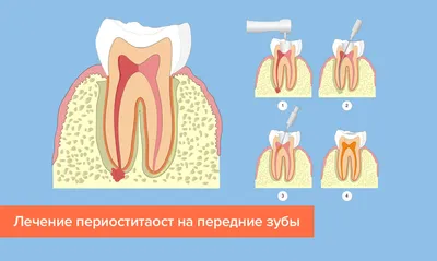 ПЕРИОСТИТ ГОЛЕНИ Воспаление надкостницы - это острое или хроническое  воспаление надкостницы. Сопровождается болями и отечностью окружающих… |  Instagram