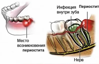 Острый периостит - причины, симптомы, диагностика, лечение