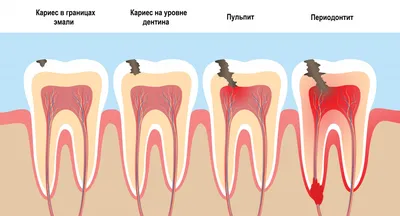 Острый гнойный периостит | Семейная стоматология