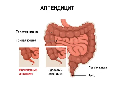 Перитонит - причины появления, симптомы заболевания, диагностика и способы  лечения