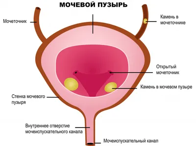 Камни в мочевом пузыре и почках у взрослых | Клиника Радуга