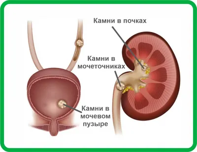 Песок в почках - YouTube