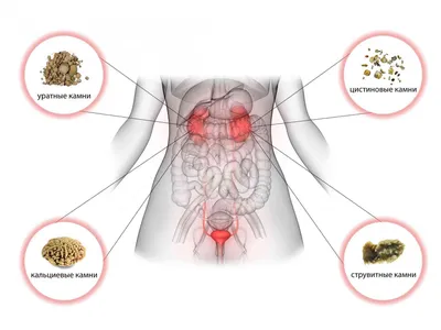 Камни в почках (нефролитиаз) - симптомы, причины, лечение, признаки