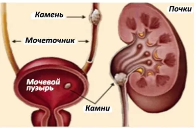 Камни в почках: почему образуются и как лечить?