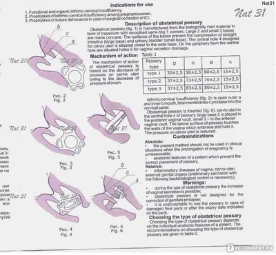 Акушерский пессарий Арабин Извлечение пессария - YouTube