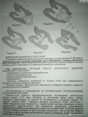 Пессарий силиконовый цервикальный перфорированный, Corefix (для беременных)  (ID#601908821), цена: 2550 ₴, купить на Prom.ua