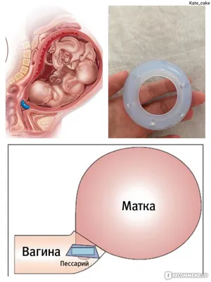 Пессарий вагинальный Dr-Arabin акушерский тип ASQ (перфорированный) - «И  помог, и навредил! Кровотечение, краевое предлежание плаценты, открытие  внутреннего зева, мягкая шейка - пессарий. Ощущения при установке и снятии.  Секс с пессарием, выделения