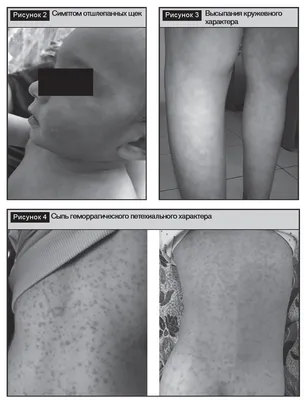 Сыпь после лихорадки у детей. Лечение сыпи у детей. - FxMed - ЦЕНТР  МОЛЕКУЛЯРНОЇ АЛЕРГОЛОГІЇ