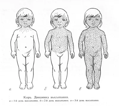 Клинические проявления парвовирусной инфекции в Узбекистане