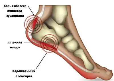 Лечение пяточной шпоры: симптомы, причины, классификация, диагностика  заболевания