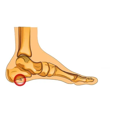 Что такое пяточная шпора, лечение пяточной шпоры в Москве