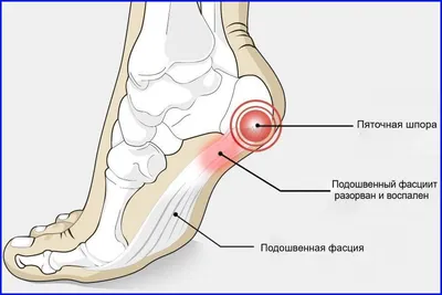 Пяточная шпора (плантарный фасциит): симптомы и лечение