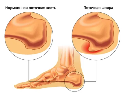 Пяточная шпора (плантарный фасциит): симптомы, причины, что делать, как  определить, как бороться