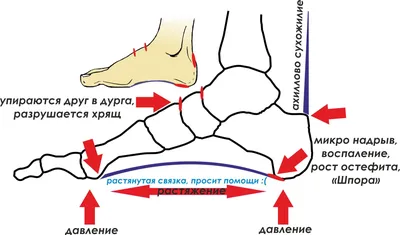 Белорусские врачи о пяточной шпоре: симптомы, причина, кто в зоне риска,  профилактика, можно ли вылечить раз и навсегда, операция - KP.RU