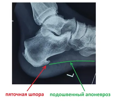 Лечение пяточной шпоры