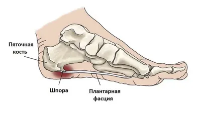 Пяточная шпора – причины и симптомы - Alimma