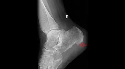 Пяточная шпора, лечение опытными специалистами в \"Эс клиник\". Избавим от  боли!