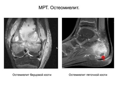 Calcaneal spur - Нейрохирургия Киев