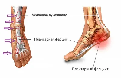 Пяточные шпоры - Остеопатия в Ярославле