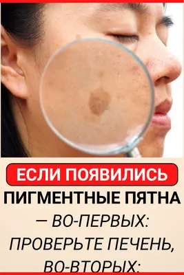 Удаление пигментных пятен BBL Sciton