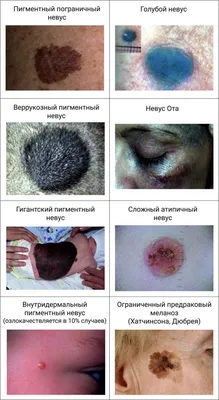 MedRussia | Медицина России - Гигантский пигментный невус — это врожденное  доброкачественное новообразование кожи, представляющее собой пигментное  пятно больших размеров (более 20 см), иногда занимающее значительную часть  конечности или туловища ...