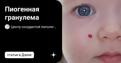 Удаление гемангиомы методом электрокоагуляции - «Маленькая неприятность, с  которой стоит быстро разобраться. Опыт удаления гемангиомы у ребенка 8 лет.  С чего началось и чем закончилось.» | отзывы