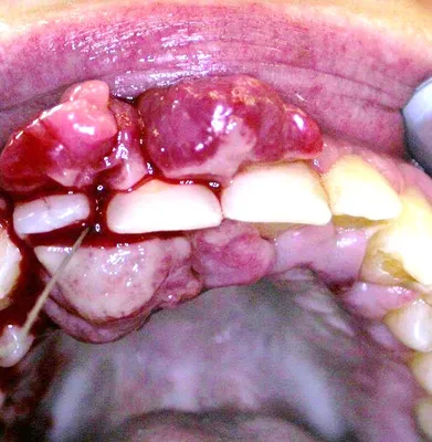 Доктор Дубин - Alphabetical index of skin diseases - Pyogenic granuloma